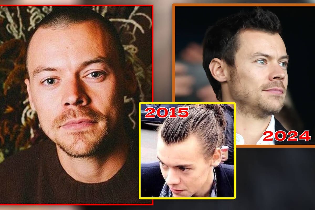 Harry “pelón” no fue un nuevo look: Cirujano plástico revela la razón por la que Harry Styles se rapó el año pasado y analiza si valió la pena