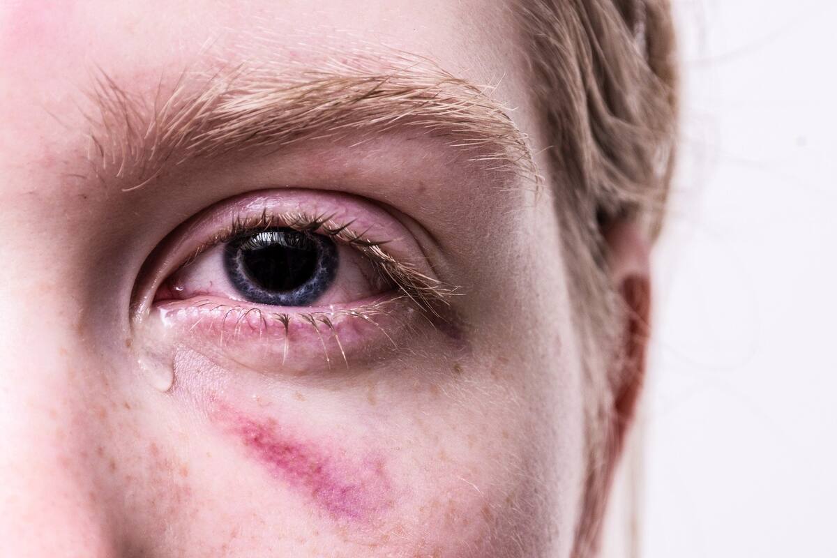 En una investigación italiana se encontró COVID-19 en una muestra ocular de un paciente