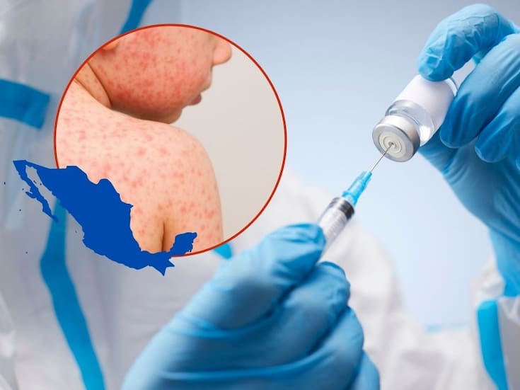 El brote de sarampión en México suma 9,478 casos confirmados y 29 muertes; Sonora acumula 53 casos