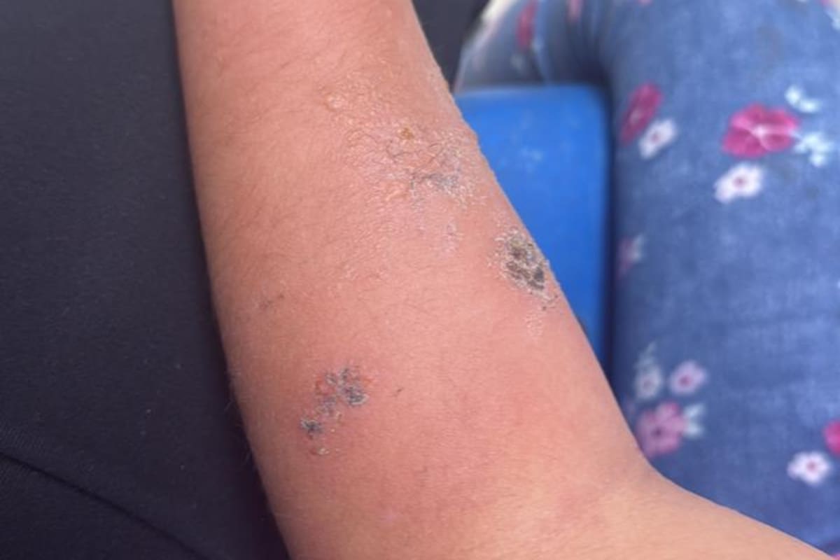 Confunden picadura de araña con la de un mosquito y no activan Seguro Escolar en Tijuana