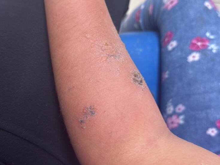 Confunden picadura de araña con la de un mosquito y no activan Seguro Escolar en Tijuana