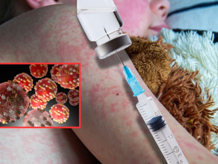 Alerta epidemiológica: Sarampión resurge con fuerza en el continente americano; los casos se disparan por 32 en un año y el 78% de los casos confirmados NO estaban vacunados