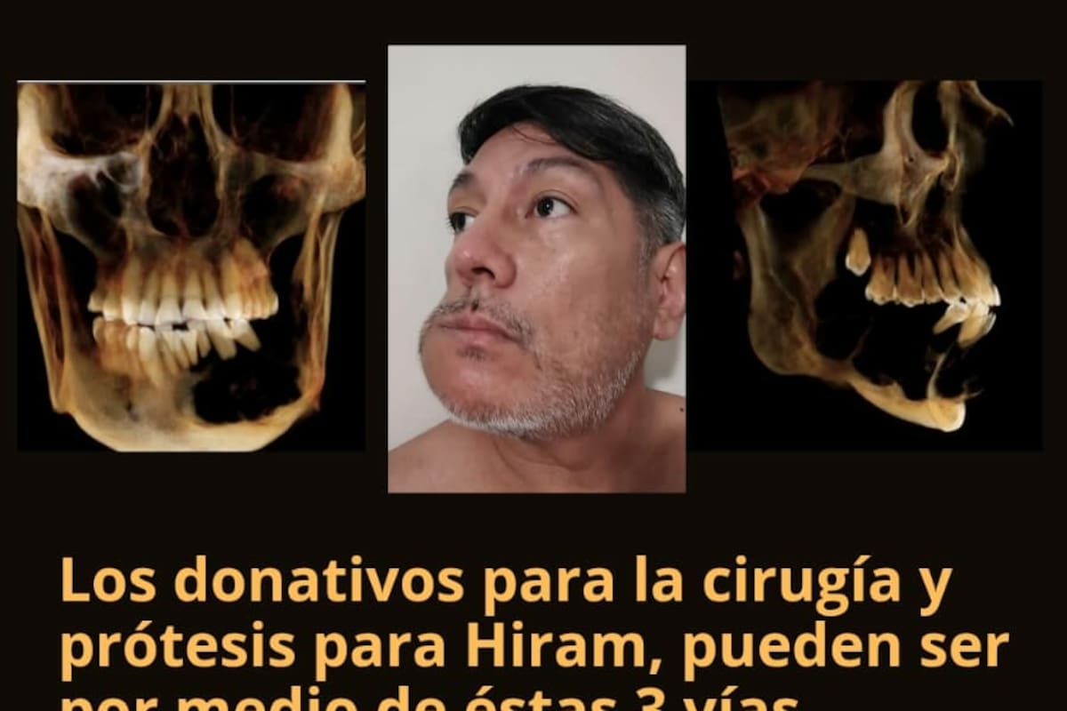 Piden apoyo para Hiram Kossio tras quedar su rostro deshecho con un ameloblastoma; extirparlo cuesta más de un millón de pesos
