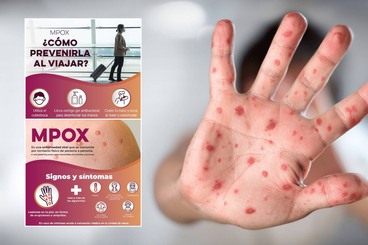 Secretaría de Salud Sonora responde ante la amenaza de MPOX (Viruela del Mono)