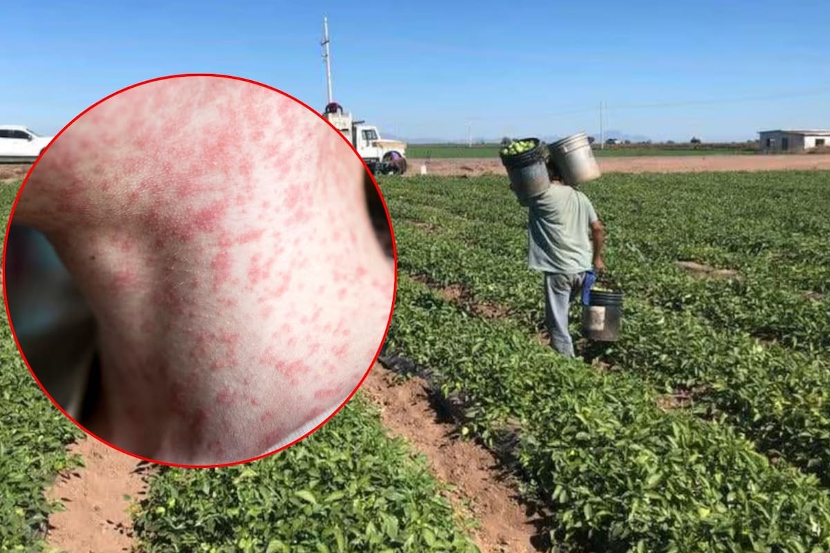 Concentran jornaleros casos de sarampión en el Sur de Sonora