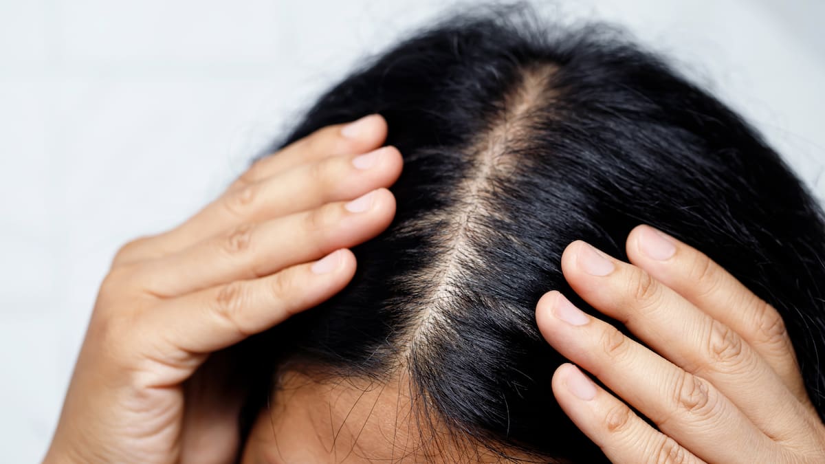 El cuero cabelludo puede causar molestias importantes cuando sufre afecciones como la alopecia androgénica, la dermatitis seborreica o la foliculitis decalvante, todas con un síntoma común: el picor persistente/Foto: Canva