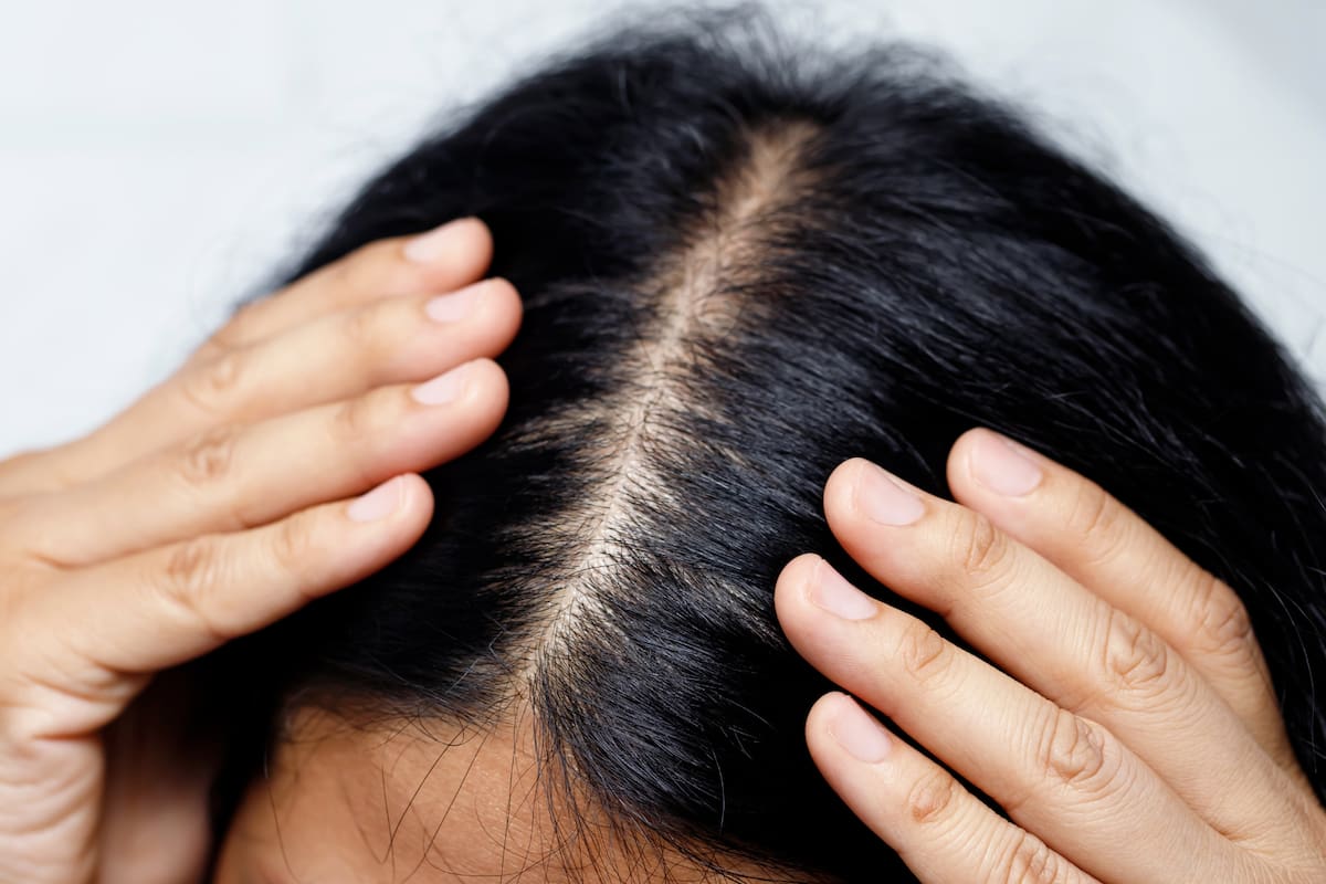 Estas son las señales que indican un cuero cabelludo poco saludable, según expertos