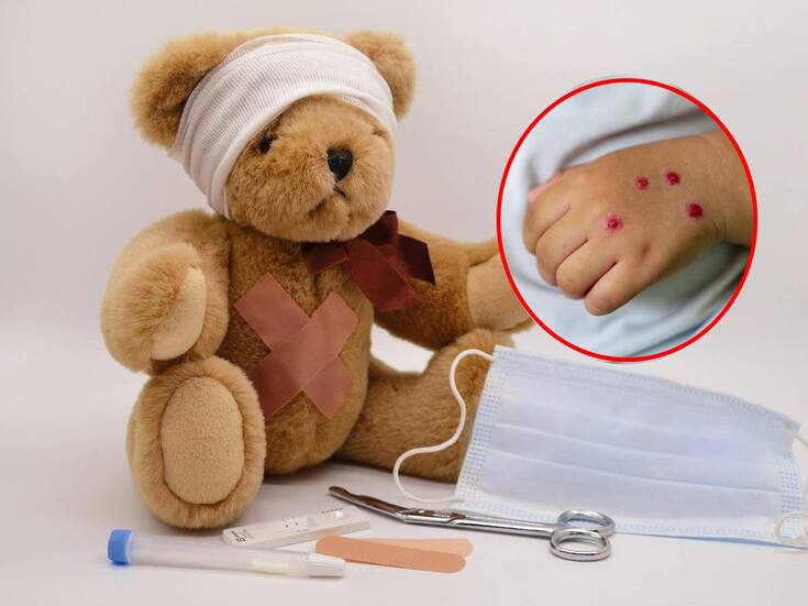 Reportan 10 casos de enfermedad “boca, mano, pie” en Mexicali