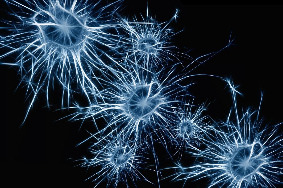 Conoce qué es la aneurisma cerebral