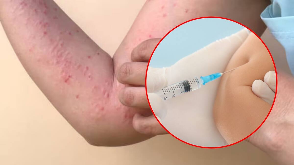 Casos de Sarampión repuntan en Europa durante el 2024 / Especial