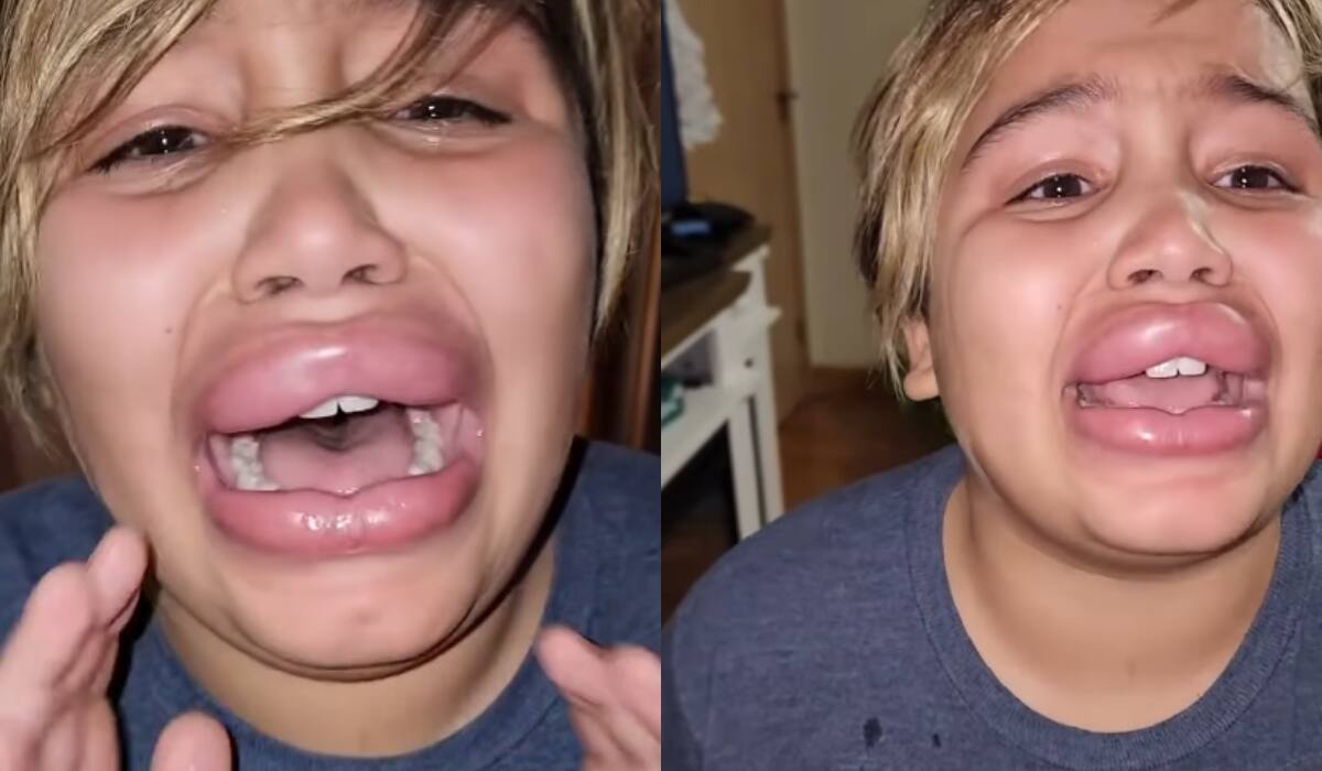 Mujer encuentra a sus hijos haciendo el Kylie Jenner Challenge y ellos temen que sus labios queden así para siempre