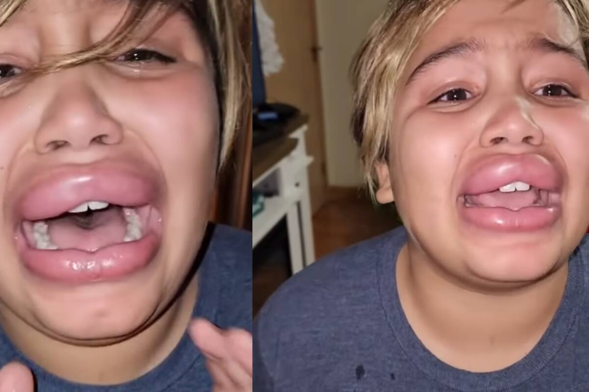 Mujer encuentra a sus hijos haciendo el Kylie Jenner Challenge y ellos temen que sus labios queden así para siempre