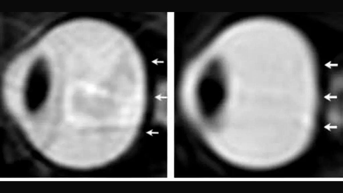 La retina es una delgada membrana ubicada en la parte posterior del ojo, cuya función resulta vital para la visión. vía Infobae