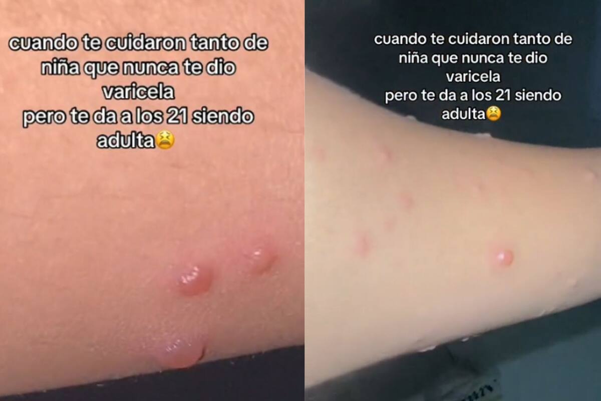 A esta mujer la cuidaron de niña para nunca contagiarse de varicela; se enferma a los 21 años