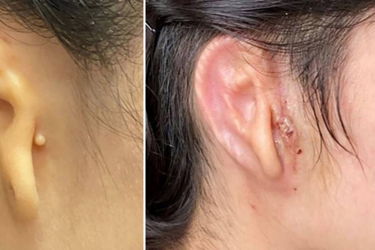 Mexicana recibe implante de oído creado en 3D con sus propias células