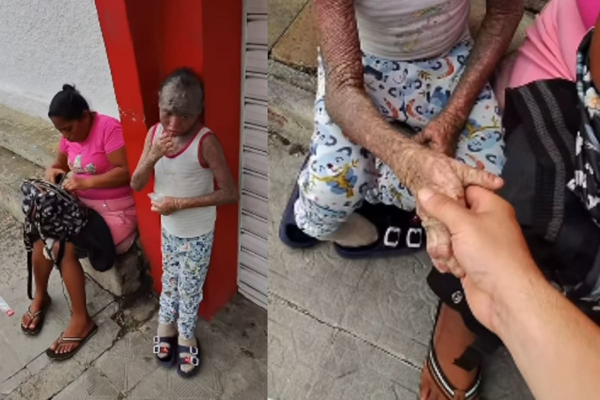 “La menor tiene ictiosis” Joven se vuelve viral por ayudar a una madre y a su hija, al tiempo que genera conciencia sobre esta poco conocida enfermedad de la piel