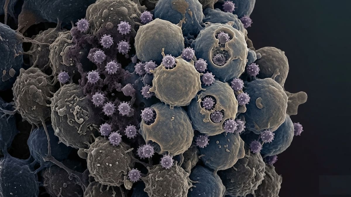 Un paciente con VIH logró dejar su tratamiento tras recibir un trasplante de células madre de un familiar con una mutación genética que bloquea la reproducción del virus, un procedimiento médico excepcional que ha permitido que el virus no sea detectable en casos muy específicos en el mundo