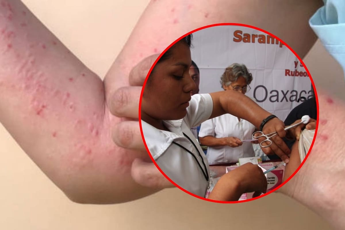 Confirman tres casos importados de sarampión en Morelos; activan cerco sanitario para evitar contagios