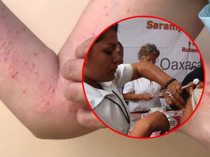 Confirman tres casos importados de sarampión en Morelos; activan cerco sanitario para evitar contagios