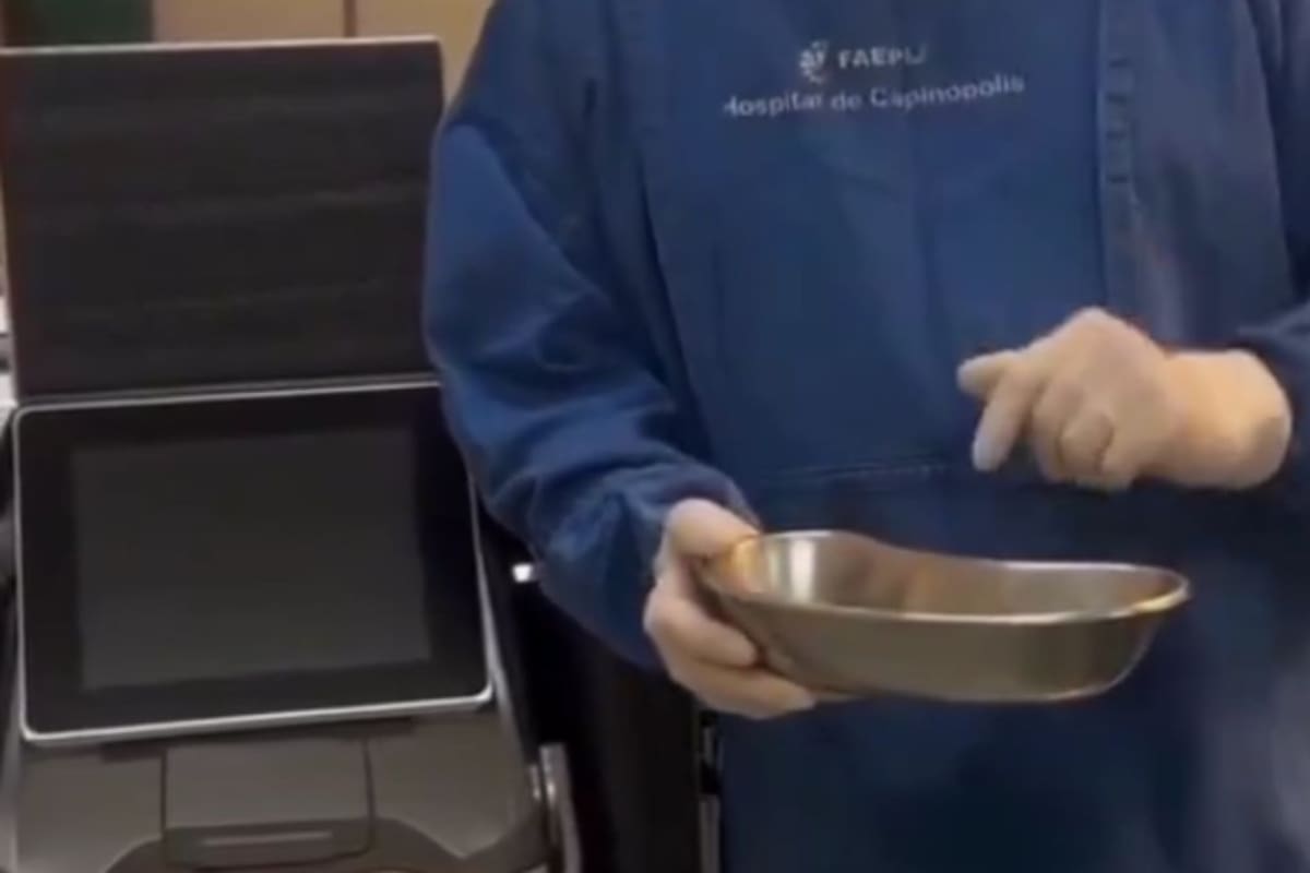 Hombre tenía 35 piedras en la vejiga y el video de la cirugía se vuelve viral en redes