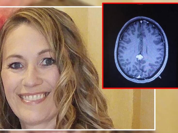 Mujer culpaba a la menopausia por sus olvidos, pero su doctor descubre que tenía un tumor en el cerebro