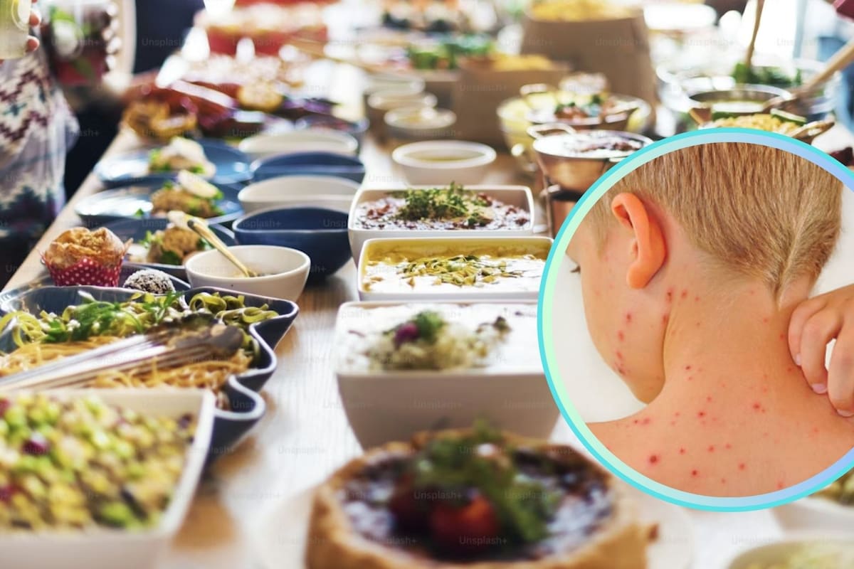 ¿Qué darle de comer a un niño con sarampión? Esto dicen los expertos