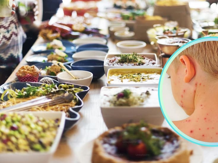 ¿Qué darle de comer a un niño con sarampión? Esto dicen los expertos
