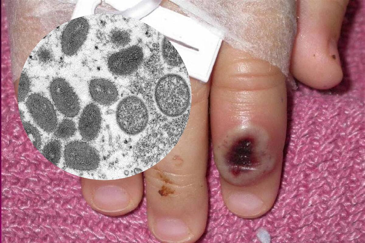 Monkeypox: ¿Vacuna contra la viruela humana protege frente a la viruela del simio?