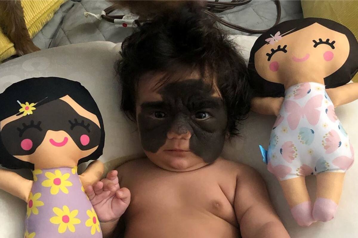 Niña nace con rara condición que asemeja tener una máscara de Batman