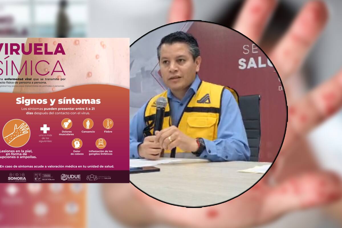 Descartan caso sospechoso de viruela del mono en Sonora; esto se sabe