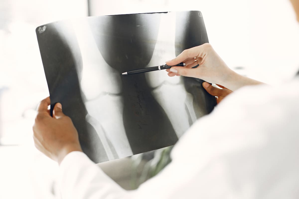 Al atravesar la menopausia aumenta el riesgo de fracturas óseas por el debilitamiento de los huesos; expertos explican cómo reducirlo