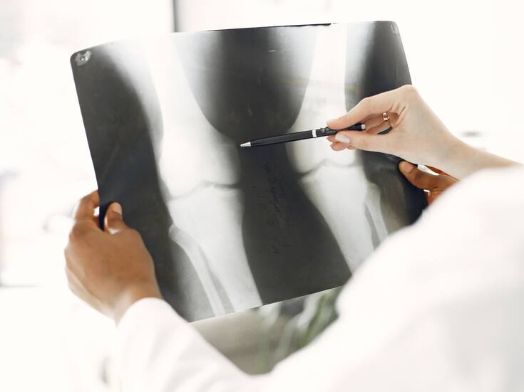 Al atravesar la menopausia aumenta el riesgo de fracturas óseas por el debilitamiento de los huesos; expertos explican cómo reducirlo