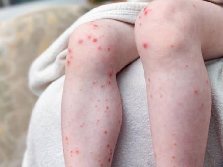 Brotes de sarampión en EEUU: autoridades piden vacunarse mientras crece debate por políticas de salud y confianza en vacunas