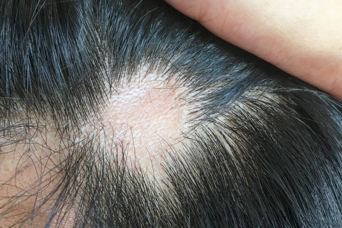 Coronavirus: qué causa y cómo tratar la caída del cabello que afecta a uno de cada cuatro infectados