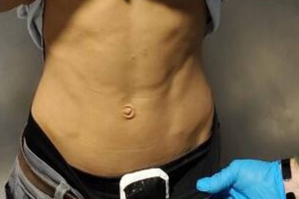 Le encuentran heroína y fentanilo pegados al cuerpo