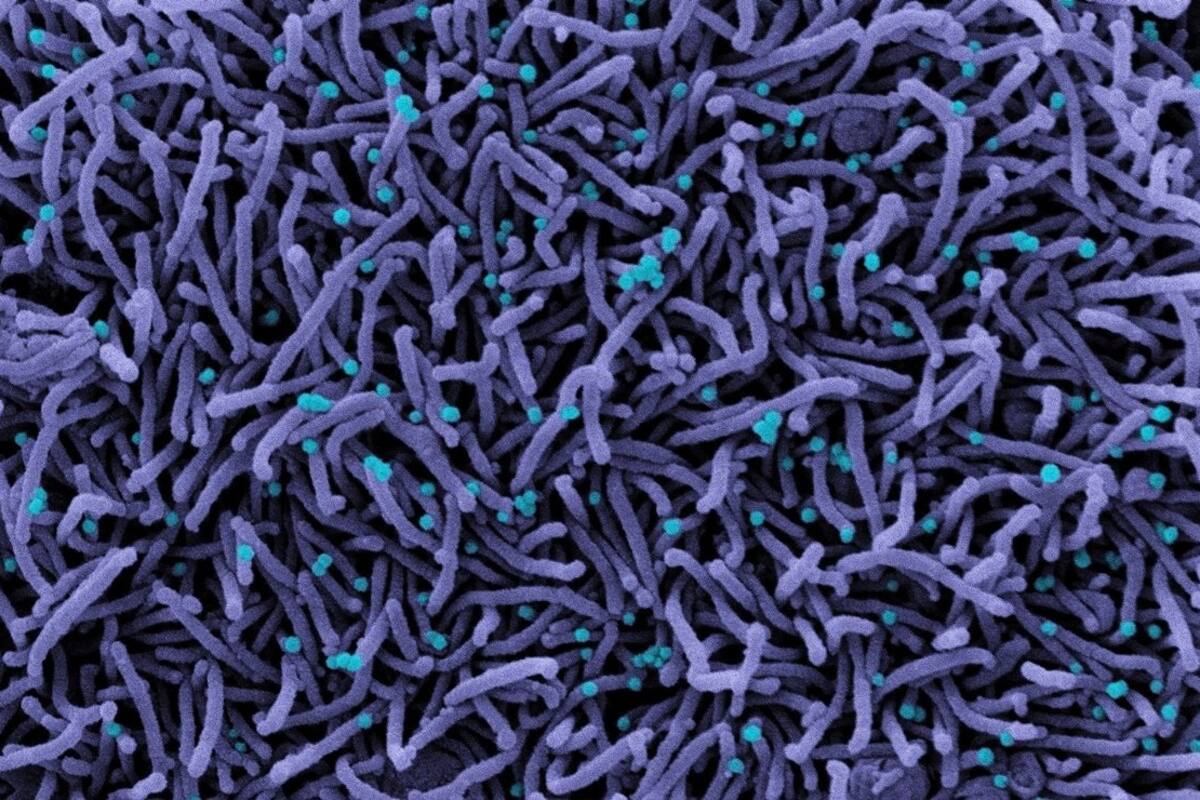 ¡Inquietante! Mapean daño por coronavirus en cerebro