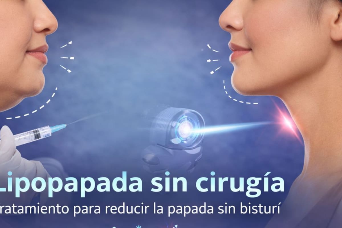 ¿Qué es la lipopapada sin cirugía y cómo funciona el tratamiento para eliminar la papada sin bisturí?