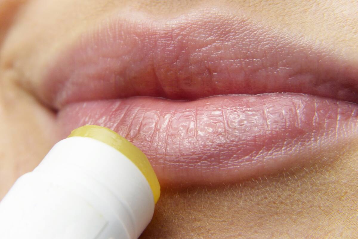 ¿Qué es el herpes labial?