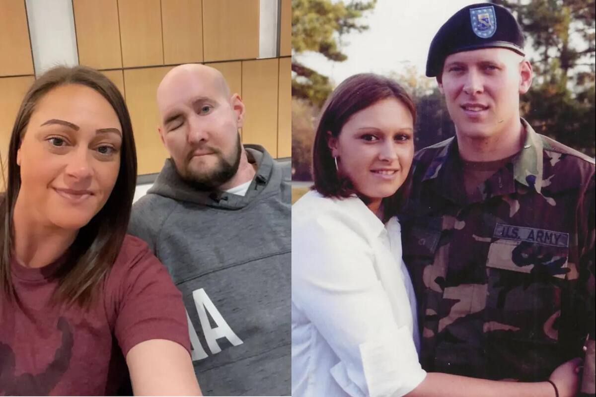 El primer paciente en el mundo con trasplante de ojo completo, un año después de la cirugía