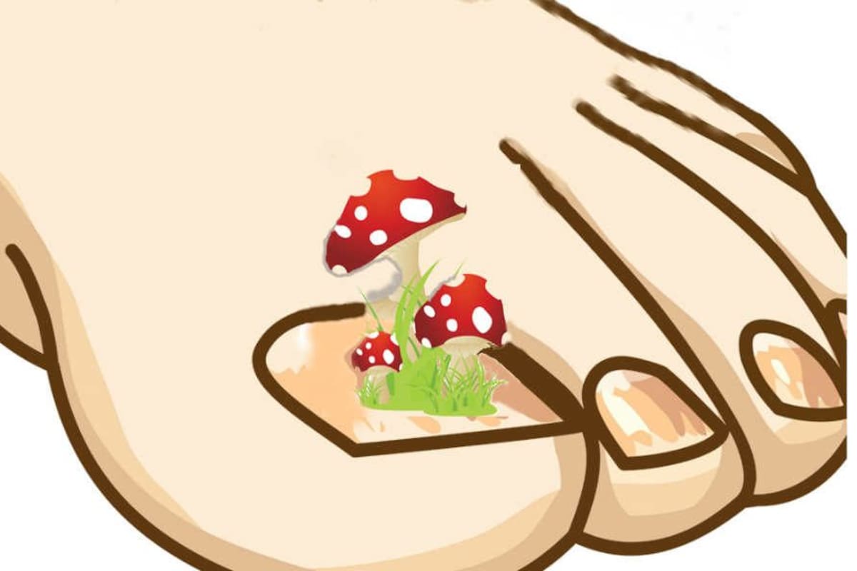 ¿Por qué se crea la onicomicosis?