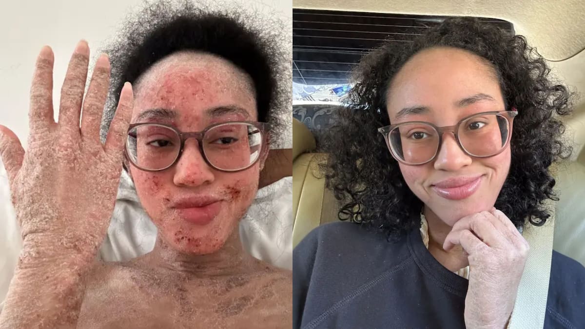 Síndrome por retiro de esteroides tópicos: la aterradora condición que, según quienes la padecen, te atrapa en tu propio cuerpo medio vivo