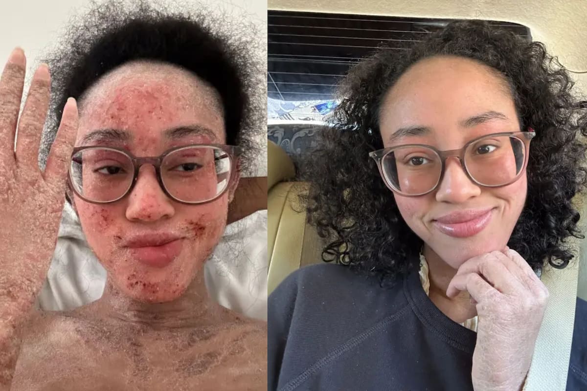 Síndrome por retiro de esteroides tópicos: la aterradora condición que, según quienes la padecen, te atrapa en tu propio cuerpo medio vivo