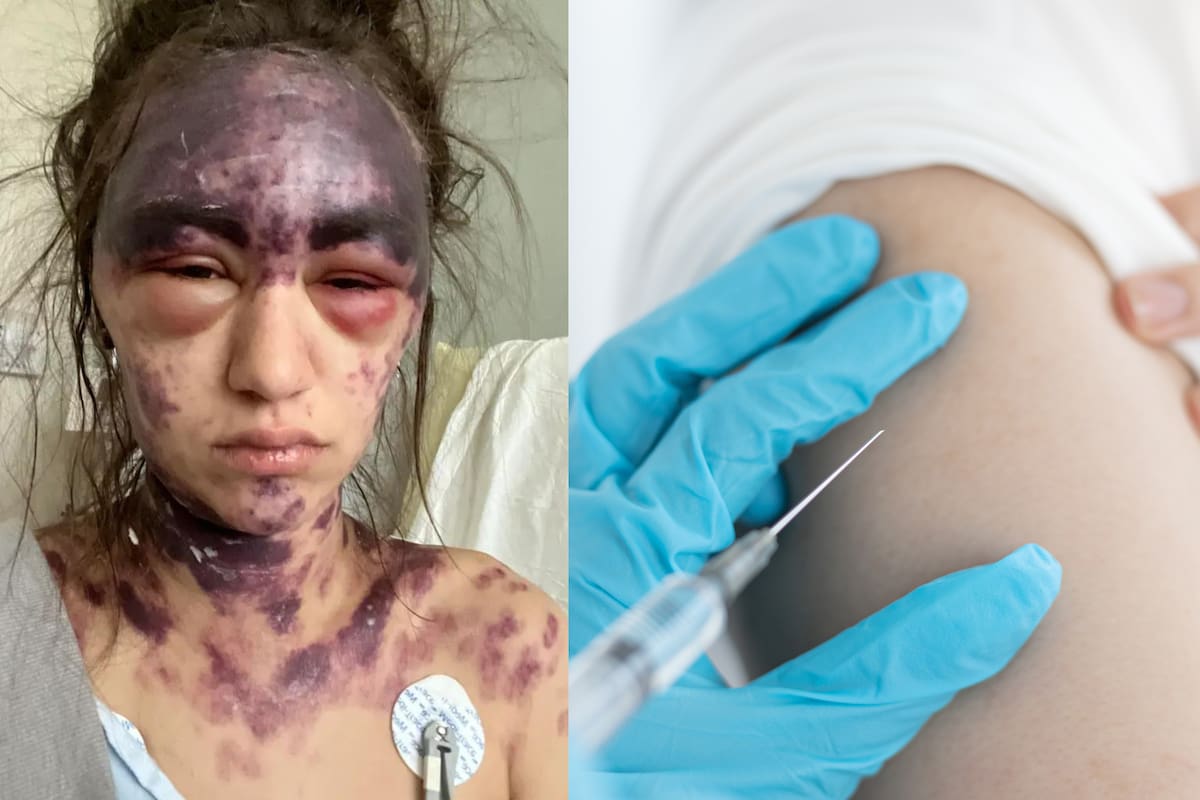 Mujer estadounidense sufre peligrosa reacción a tres vacunas, con sintomas como vómitos y hinchazón y moretones en todo el cuerpo
