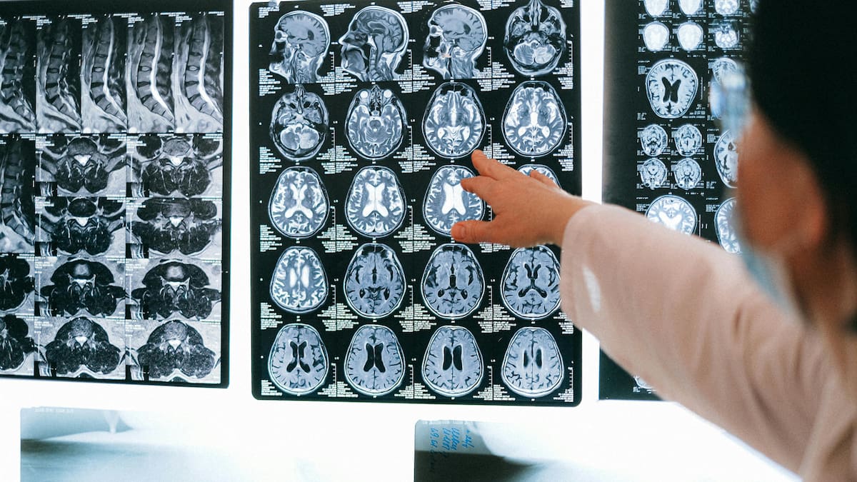 Investigadores en Barcelona confirman que combinar un fármaco trombolítico con la trombectomía mejora la evolución del ictus grave, un hallazgo que podría cambiar los tratamientos actuales al aumentar la recuperación de los pacientes a los 90 días
