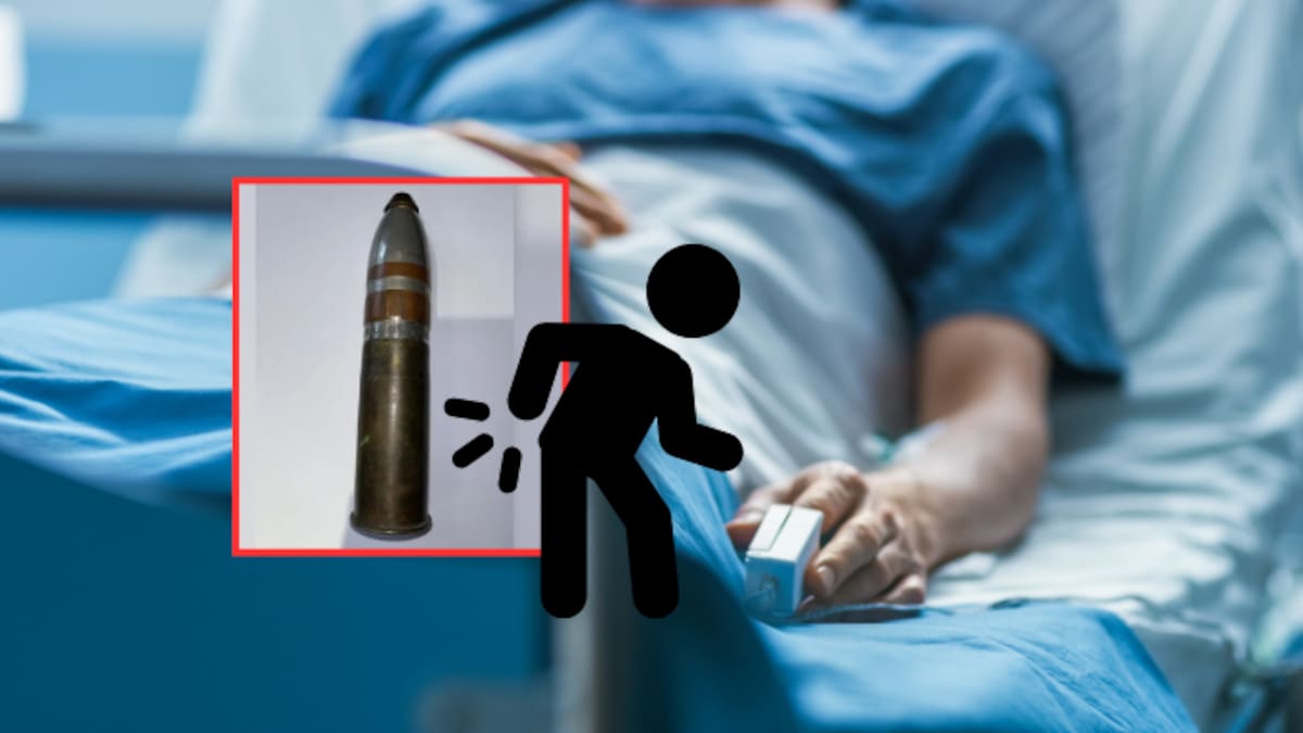 Extraen proyectil de 16 centímetros del recto de un hombre de 24 años en Francia; el artefacto todavía contenía material explosivo activo y el joven podría enfrentar consecuencias legales