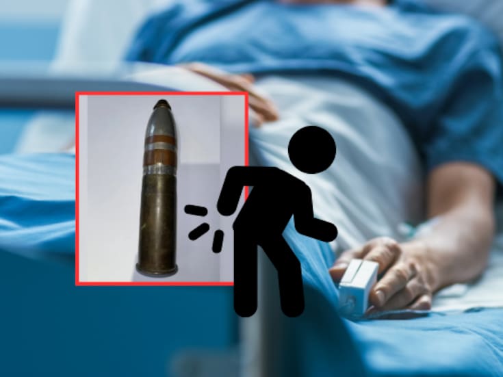 Extraen proyectil de 16 centímetros del recto de un hombre de 24 años en Francia; el artefacto todavía contenía material explosivo activo y el joven podría enfrentar consecuencias legales