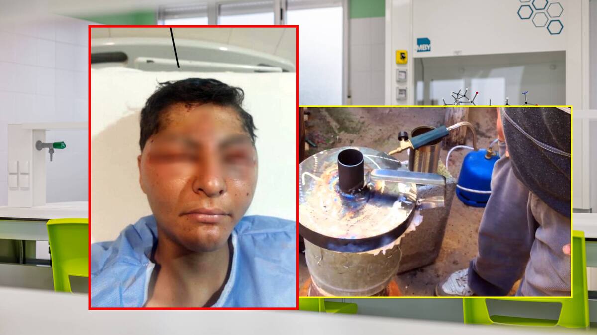 Le dejaron de tarea fundir aluminio desde casa y le explotó en el rostro; mamá denuncia que escuela intentó sobornarla con 75 mil pesos para decir que fue un “accidente” dentro de la escuela