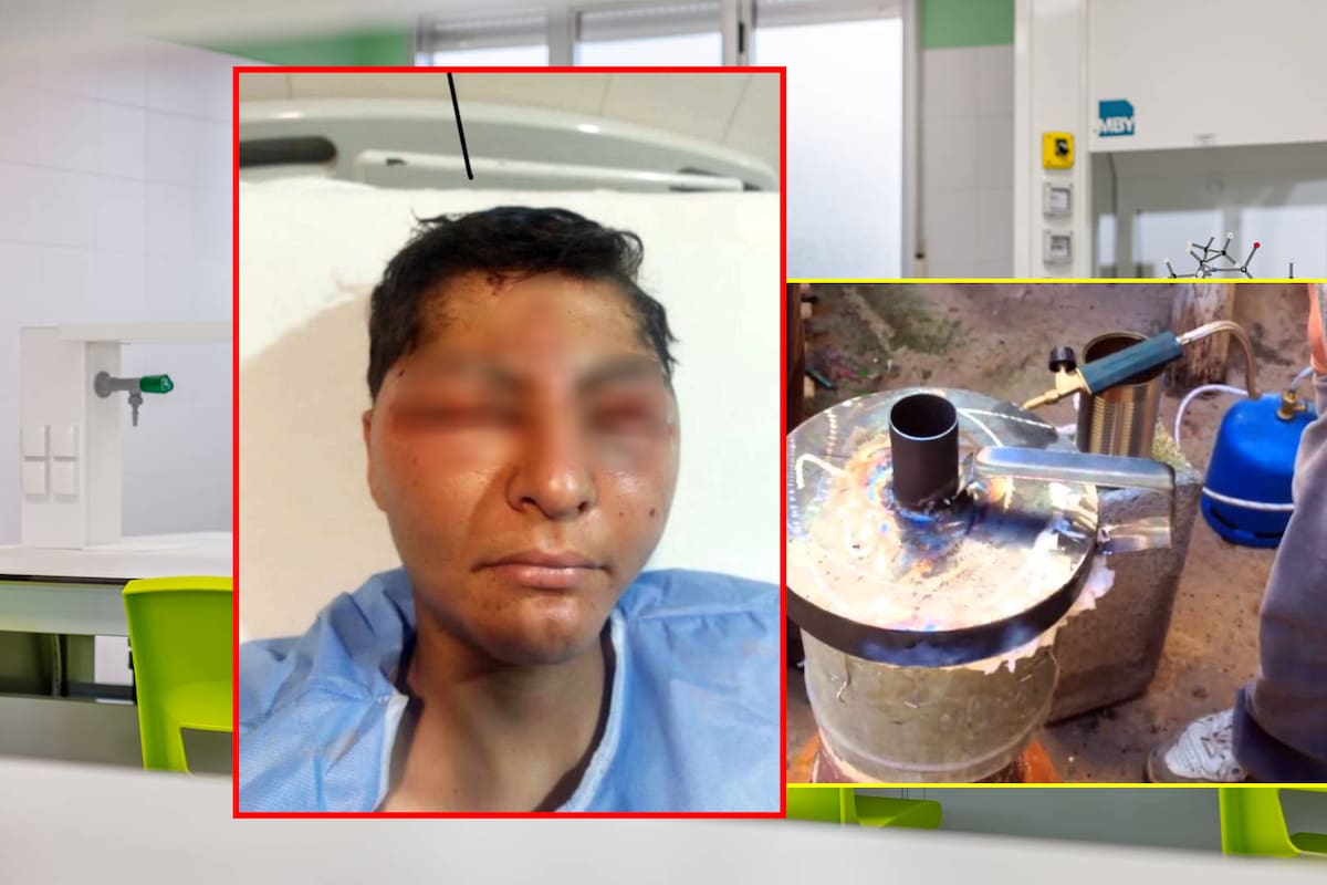Le dejaron de tarea fundir aluminio desde casa y le explotó en el rostro; mamá denuncia que escuela intentó sobornarla con 75 mil pesos para decir que fue un “accidente” dentro de la escuela