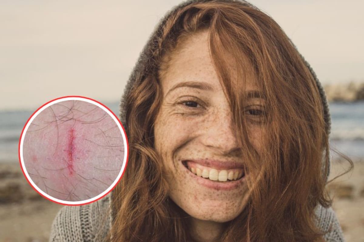 Cuando la piel no sana: la inesperada pista escondida en el gen de los pelirrojos