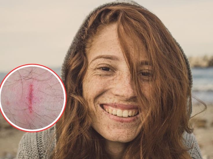 Cuando la piel no sana: la inesperada pista escondida en el gen de los pelirrojos